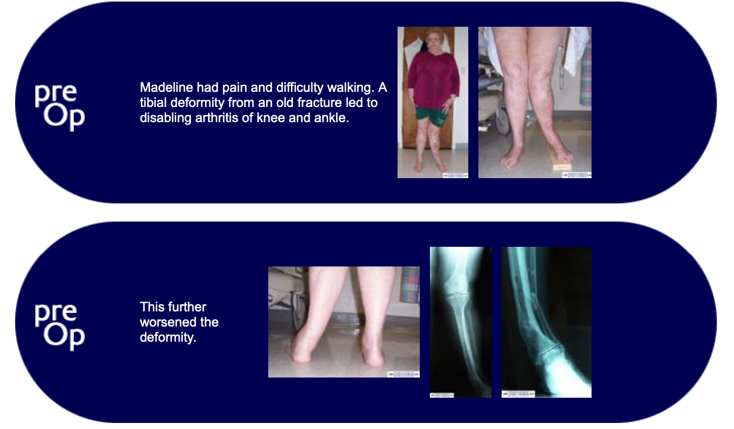 Pre-op images of knock knee patient