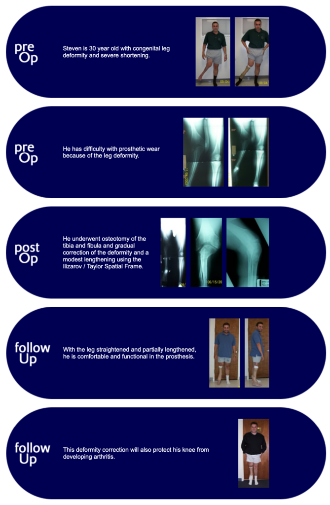 Steven, patient with congenital deformity needs prosthetic